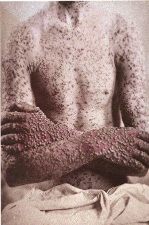 Viruela. La Organización Mundial de la Salud lo declaró erradicado en 1979. Por este virus murieron más de 300 millones de personas en el mundo en el Siglo XX. Atacaba principalmente a los niños.