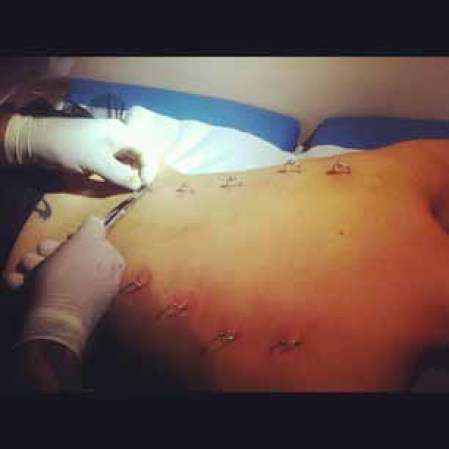 Se pueden hacer en el brazo, la pierna, o una variedad de otras ubicaciones en el cuerpo.