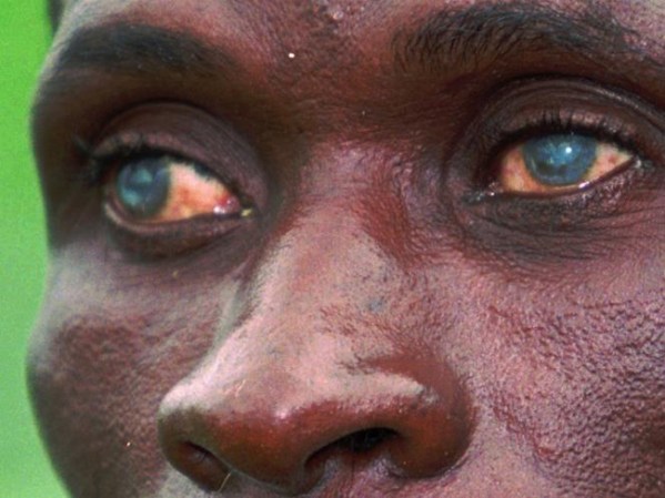 Se la conoce como “ceguera de los ríos” porque las larvas de la mosca negra se reproducen en ríos de corriente rápida. Esta enfermedad es endémica en África, donde es la principal causa de ceguera.