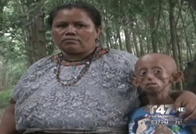 16 DE OCTUBRE, 2012: Una niña conmueve al mundo tras una extraña y dolorosa enfermedad.