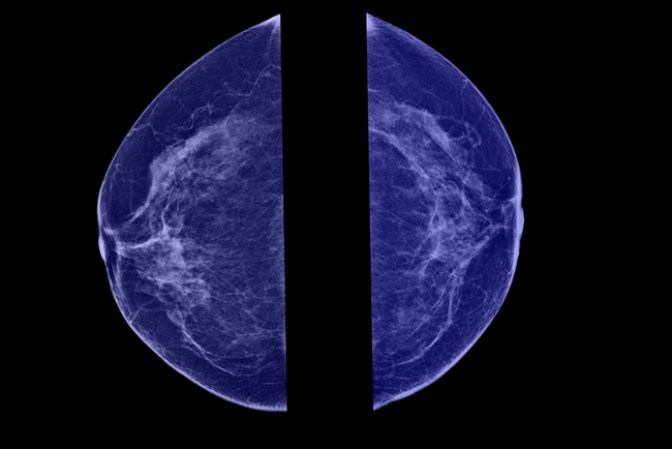 Cuando se reducen las mamas, la areola y pezón quedan irrigado solo por dos arterias cuando normalmente es irrigado por cuatro.