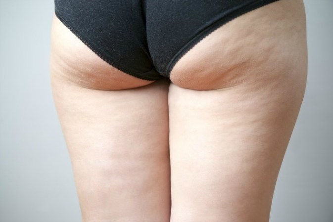 5. Afecta a las mujeres fuera de forma. El sobrepeso hace que la apariencia de la celulitis sea más visible. Si tienes más grasa de lo recomendable debajo de la piel, habrá más presión sobre el tejido conectivo.