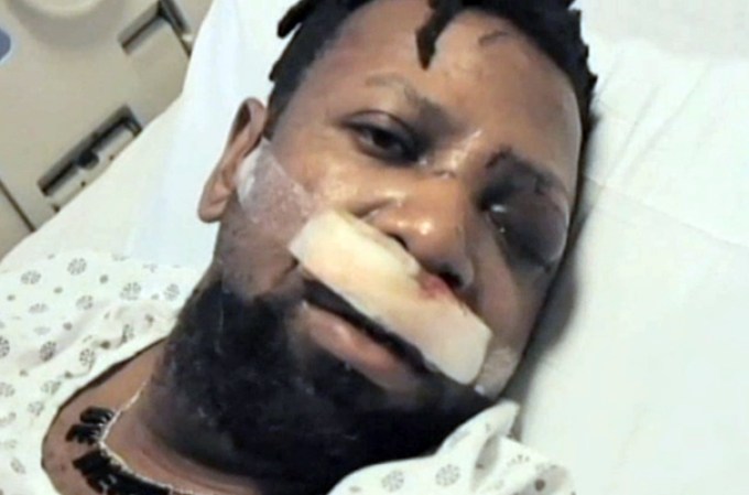 El sospechoso atacó despiadadamente a la víctima con un martillo, causándole perder su ojo izquierdo.