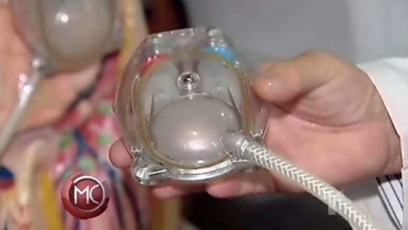 Implante exitoso de corazón artificial...El hombre vive en México donde se hizo una extraordinaria cirugía de un corazón artificial. Podría sentar precedentes a otros pacientes que sufren de insuficiencia cardíaca y puedan salvar su vida. Mira la historia en video aquí
