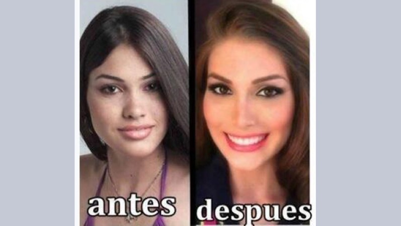 NOVIEMBRE, 2013: Tras su coronación como Miss Universo 2013, la venezolana Gabriela Isler aseguró que nunca ha pasado por el quirófano luego de que comenzara a circular una foto suya con facciones menos estilizadas. <br /><br /> Miss Universo niega cirugías<br /><br />