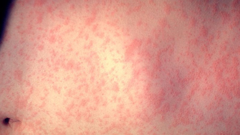 Rubeola. En los últimos 150 años este virus ha matado a más de 200 millones de personas.