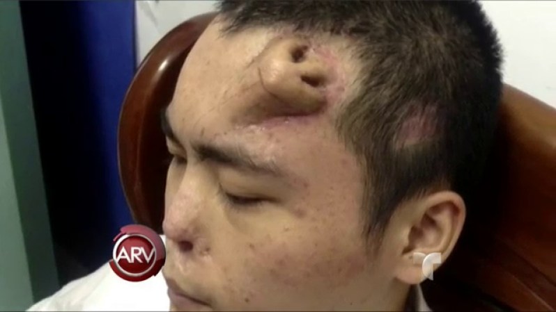Un paciente chino que perdió su nariz en 2012 está esperando que le crezca una nueva, pero en la frente.<br /><br /><br /> Le crece una nariz en la frente <br />