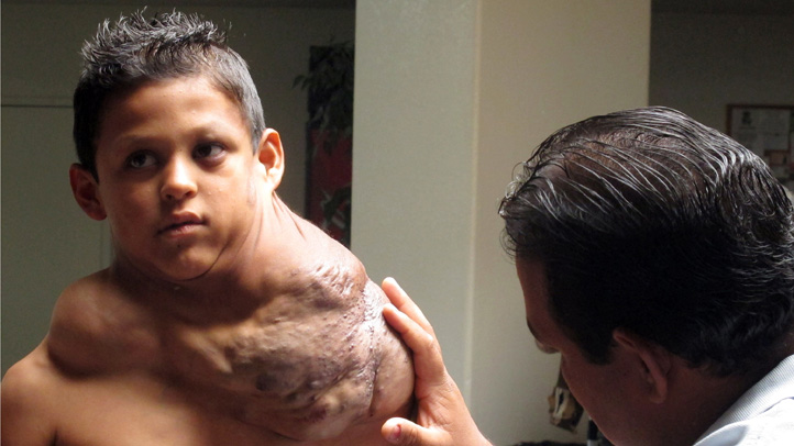 José fue diagnosticado con un linfangioma venoso en el hombro, y los médicos del hospital de la Universidad de Nuevo México le dijeron que debe someterse a una serie de cirugías y tratamientos para remover la enorme masa de fluido.
