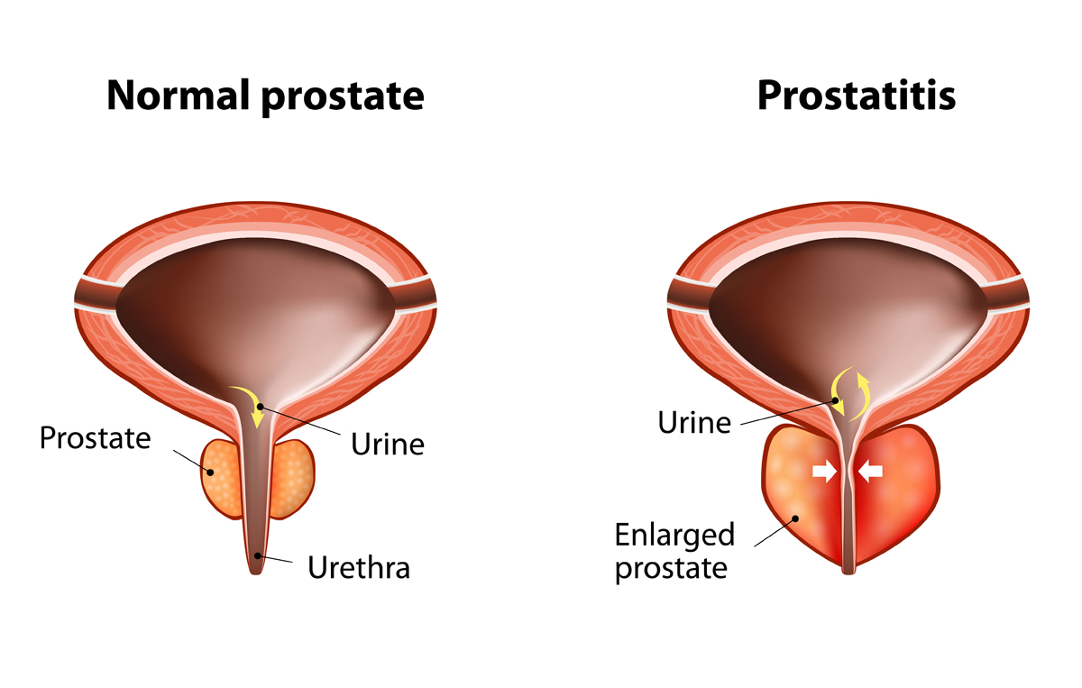 ¿Qué tipo de urnie oddro es común con la prostatitis?