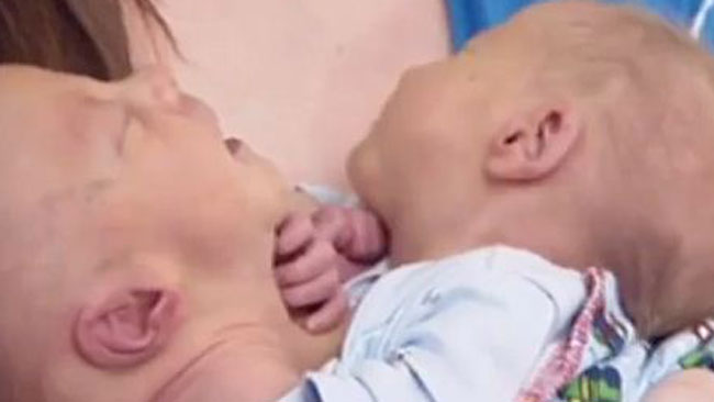 tlmd_bebes_siameses_ok1