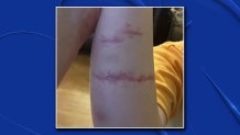 The family of Nathan Williams says he has suffered permanent scarring after being injured during a May 2, 2021 visit to the Dallas World Aquarium.