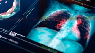Exploración por RMN médica/ pulmón