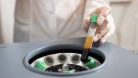 Plasma rico en plaquetas: qué es y para qué se utiliza