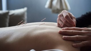 An acupuncture session