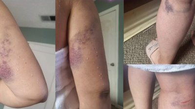 Vendedora de pupusas sufre graves heridas tras ser arrollada en East Palo Alto