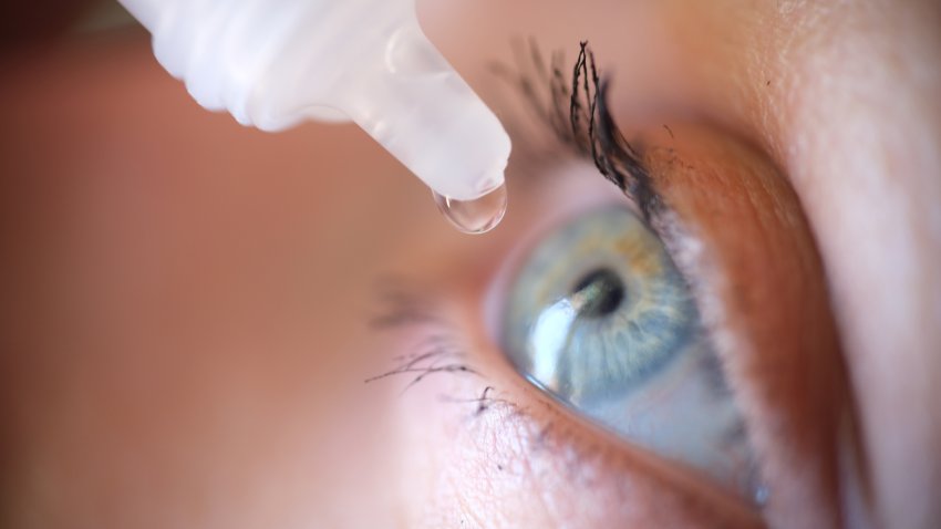 Drops from vial dripping into woman eye closeup. Conjunctivitis treatment concept