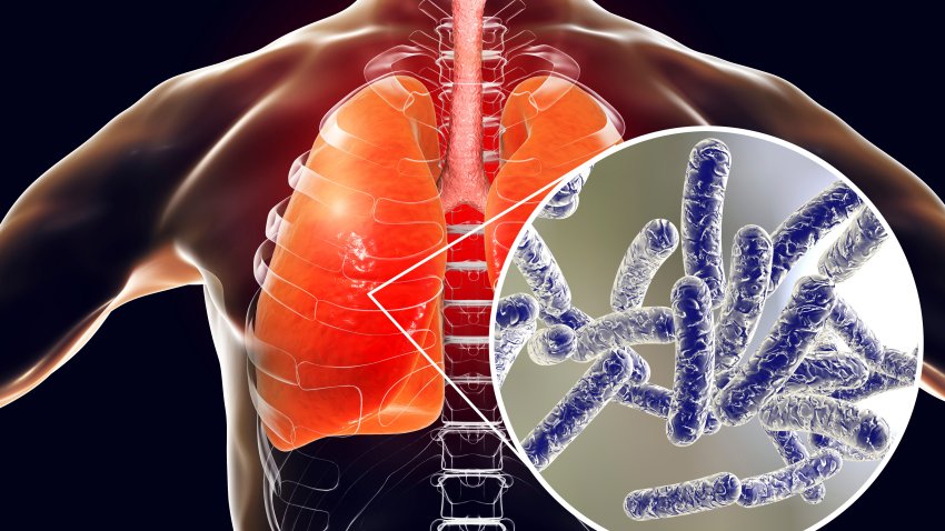 Legionella pneumophila bacteria in human lungs, 3D illustration, the causative agent of Legionnaire’s disease