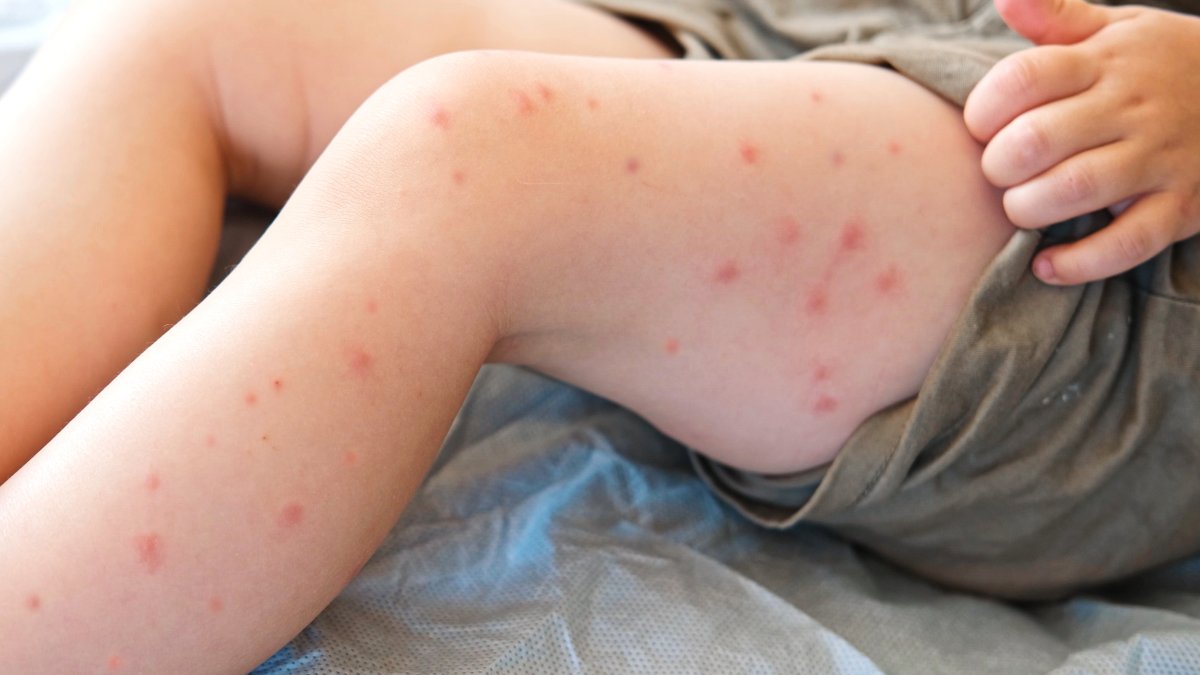 Tercer caso de sarampión en Virginia: aquí los lugares y fechas de posible exposición