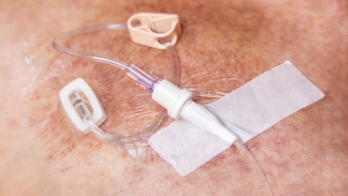 Nuevo logro en la lucha contra el cáncer: 7 de cada 10 pacientes sobreviven más de cinco años