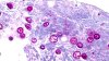 Detectan cerca de 400 casos de ciclosporiasis en NY, una infección parasitaria que causa diarrea