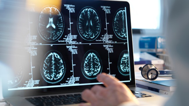 Como detectar derrame cerebral
